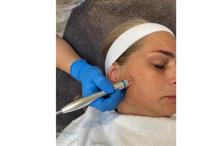 Dermapen4 Microneedling behandeling bij Apotheek&Beauty Monster