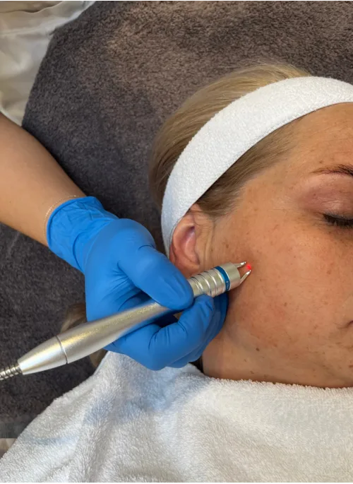 Laserbehandeling gezicht bij Apotheek&Beauty Monster