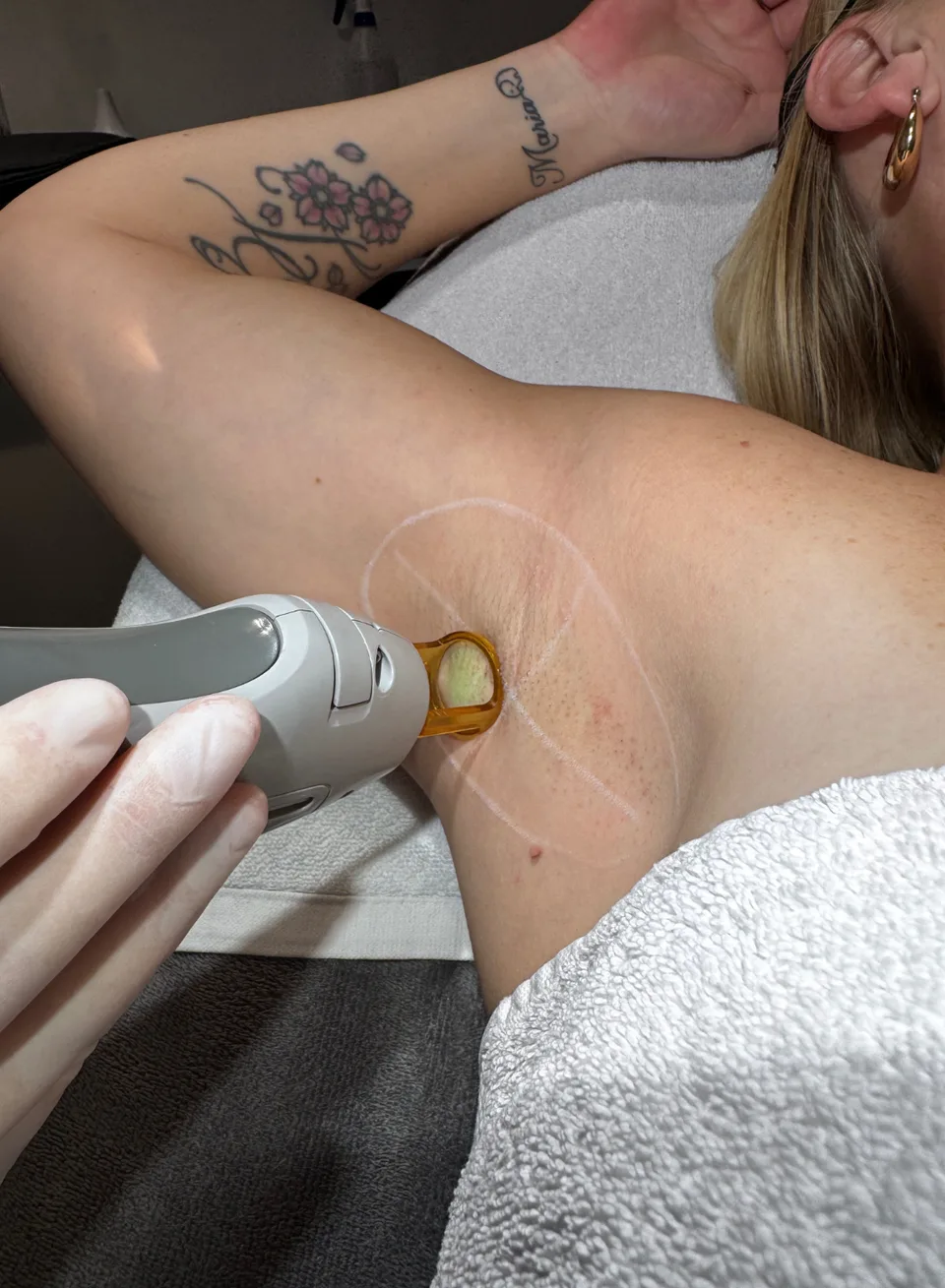 Laserontharing behandeling bij Apotheek&Beauty Monster