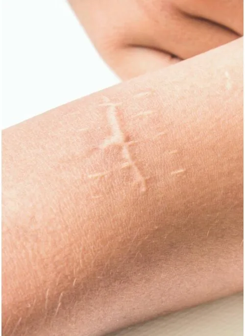 Microneedling behandeling bij Apotheek&Beauty Monster