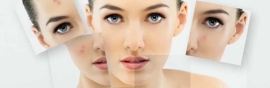 Acne bij Apotheek&Beauty Monster
