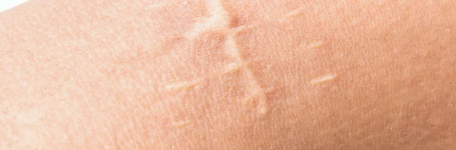 Littekens bij Apotheek&Beauty Monster