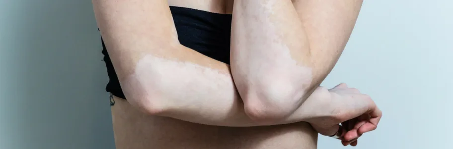 Vitiligo bij Apotheek&Beauty Monster